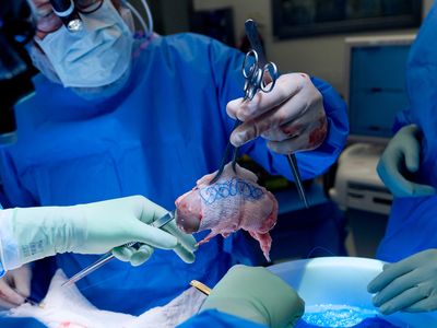 Doctors at NYU Langone Health recently performed a transplant surgery using a gene-edited pig kidney. The patient, Towana Looney, is now more than two months out from surgery and recovering well,