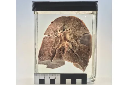 Formalin-fixed lung collected in 1912 in Berlin from a 2-year-old girl who died of measles-related pneumonia