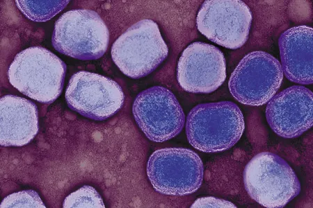 The last natural case of smallpox was recorded 
in Somalia in 1977.