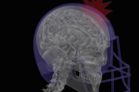 A concussion occurs when the brain impacts the inside of the skull with enough force to temporarily affect brain function. 