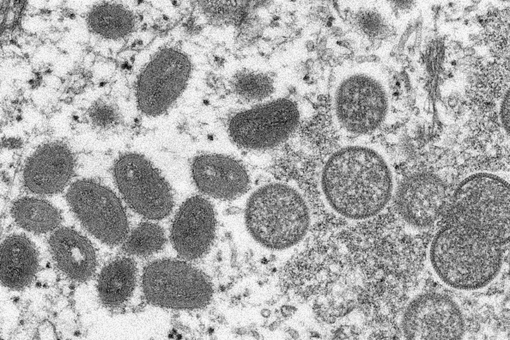 Microscopic view of the monkeypox virus