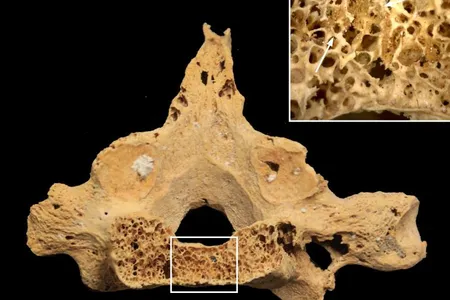 A vertebrae from the remains, with a close-up of a cancerous growth (indicated by white arrows). 
