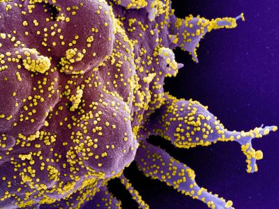 Electron microscope image of a human cell (purple) heavily infected with SARS-CoV-2 virus particles (yellow)