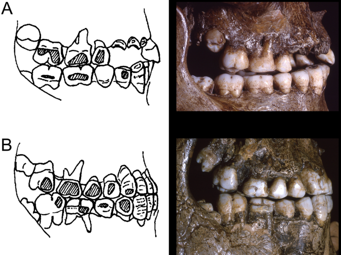 Graphic that shows wear patterns on teeth