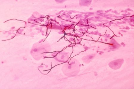 The fungus Candida albicans in a patient with pulmonary candidiasis. Humans are home to trillions of harmless cells of bacteria, fungi and other microbes that play an important role in our health.