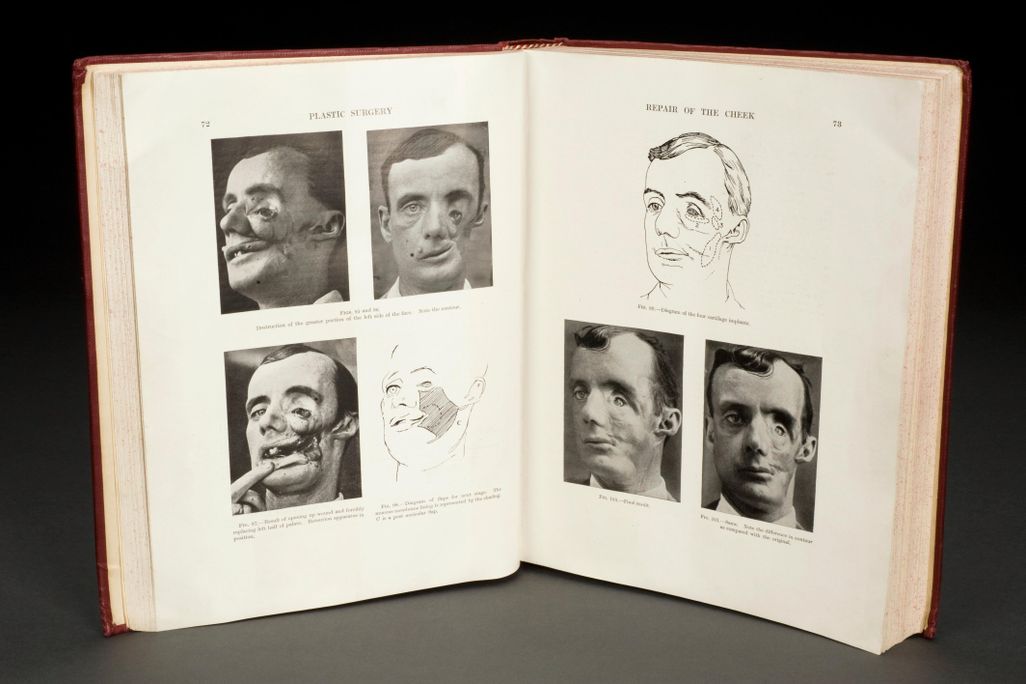 Pages from Plastic Surgery of the Face by Harold Gillies