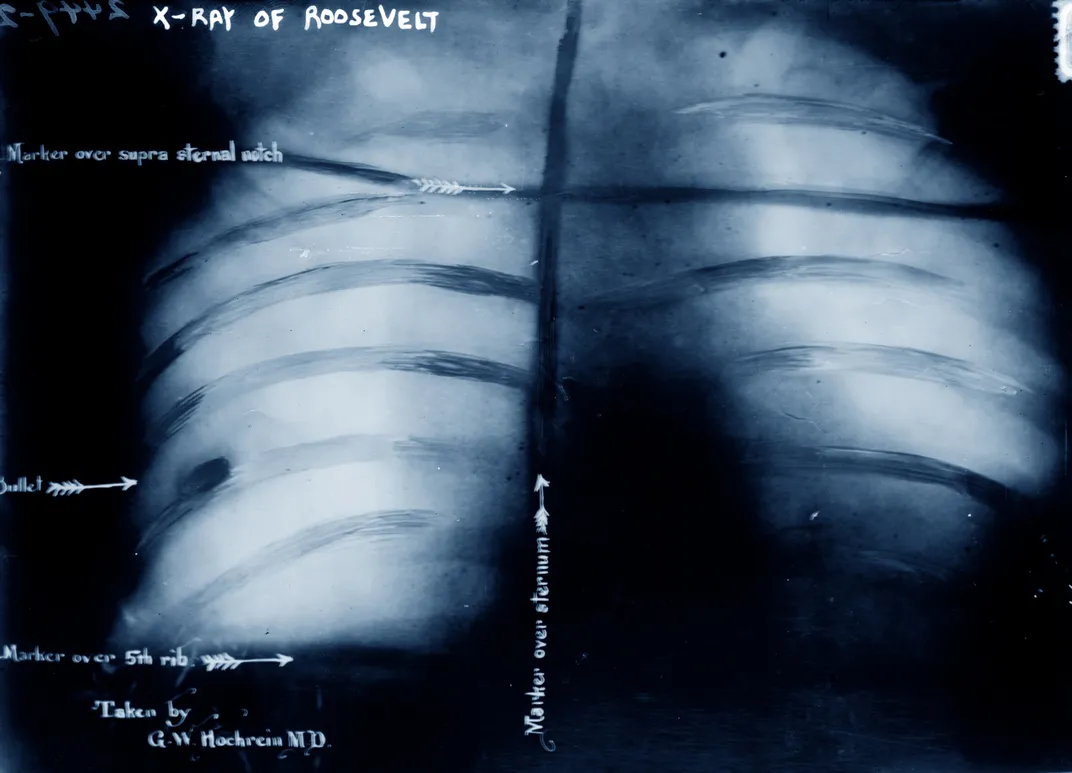 X-ray of Roosevelt