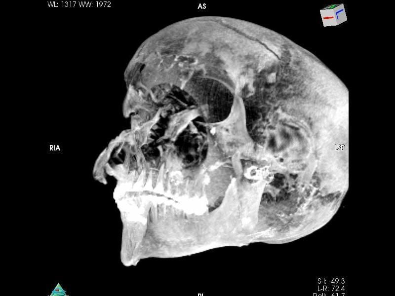 X-ray image of mummy's head