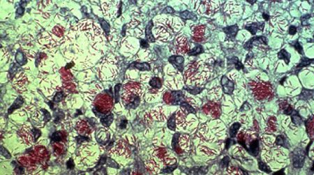 Mycobacterium leprae, in red.