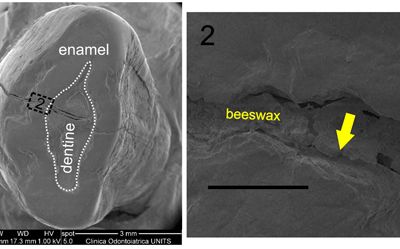A scanning electron microscope image of the ancient tooth, and the location of the beeswax filling.