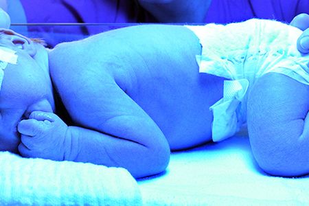 Jaundice is usually treated with short-wave blue light.