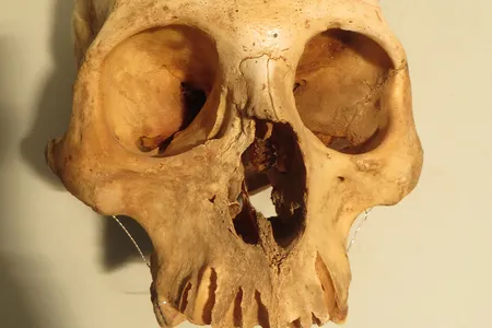 The cranium of an adult male, likely 25 to 30 years old, shows healed trauma affecting the upper jaw. The injury was probably caused by a punch from another individual in a fight.