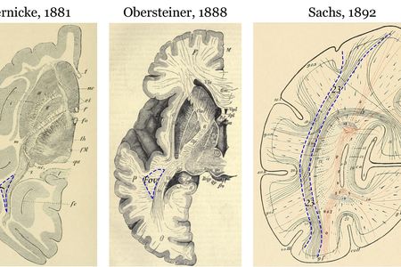 Early images of the vertical occipital fasciculus, a brain region involved in processing visual information