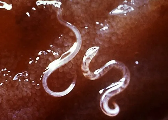 Parasitic hookworms in a person’s intestinal lining.