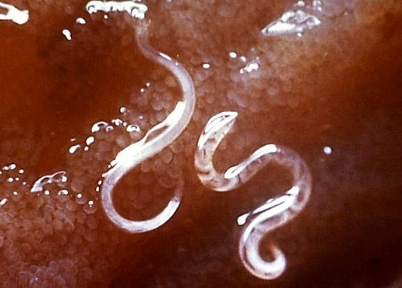 Parasitic hookworms in a person’s intestinal lining.