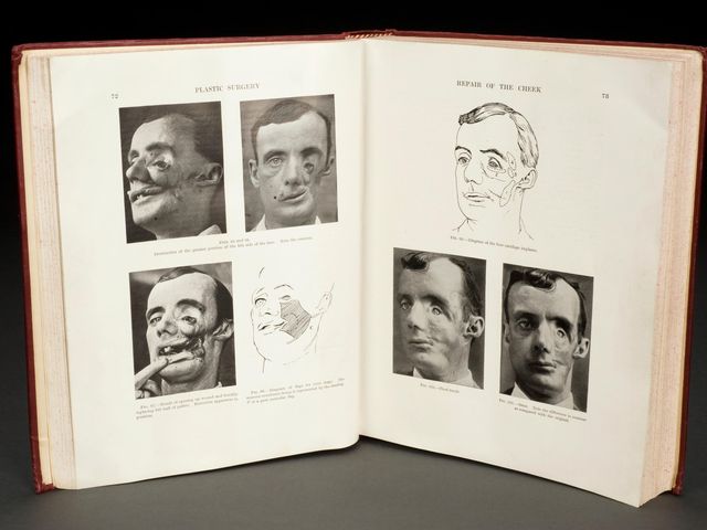 Pages from Plastic Surgery of the Face by Harold Gillies