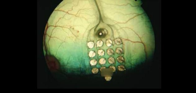 The system uses a grid of surgically implanted electrodes to enable a blind person to “see” the letters.