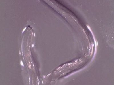 Eye worm extracted from Beckley