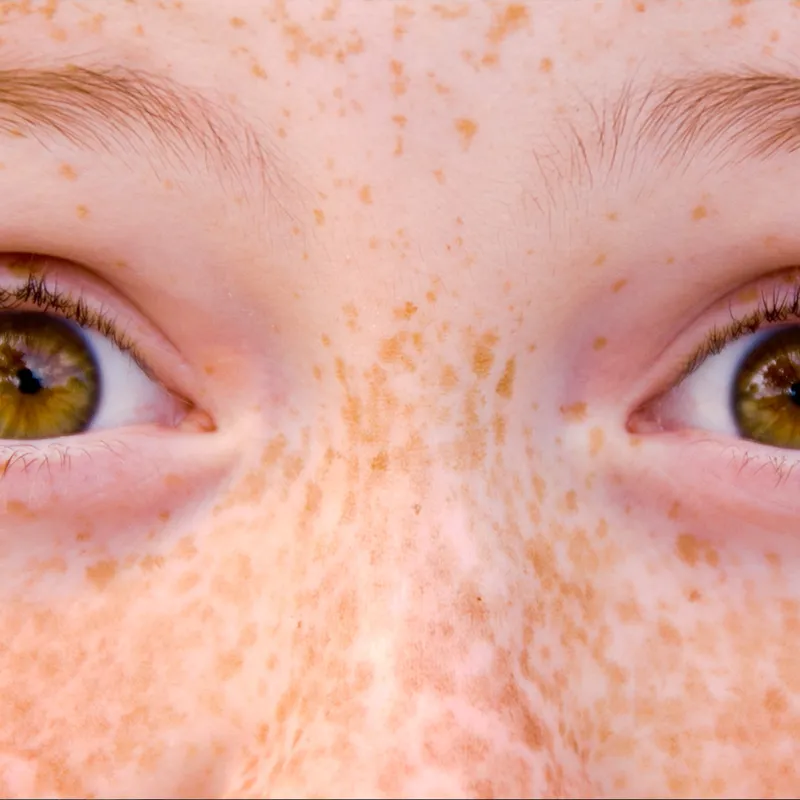 the-beauty-of-freckles-exploring-the-different-names-for-56-off