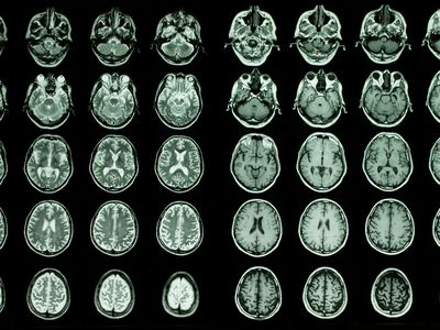 Researchers looked at brain scan data and results from blood tests to search for correlation between certain proteins and brain aging.
