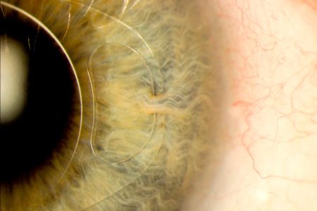 This image shows how an iris clip, also known as an intraocular lens, is fitted onto the eye. The clip is a small, thin lens made from silicone or acrylic with plastic side supports to hold it in place. It is fixed to the iris through a tiny surgical incision and can treat cataracts and near-sightedness. 
