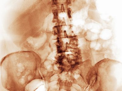 This man's spine wasn't cut by a knife, but rather is degenerating from arthritis. 