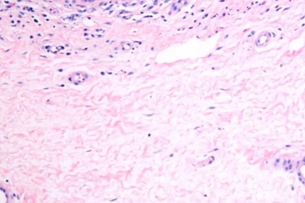 Dermal interstitium