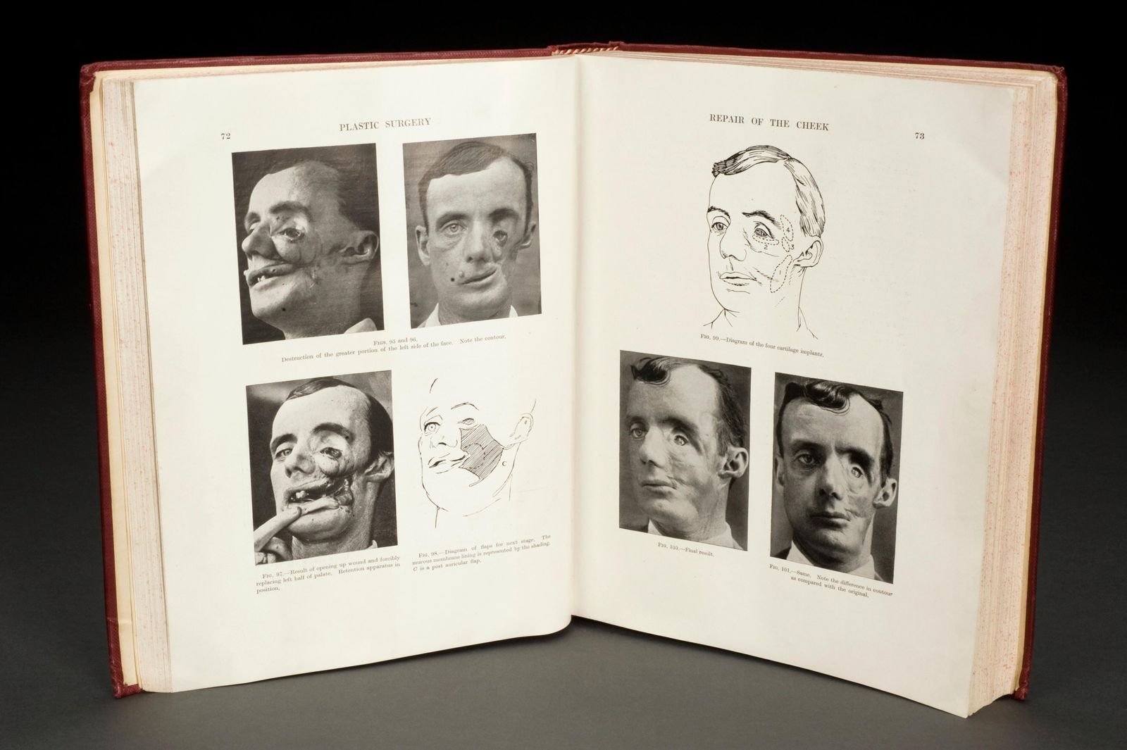 Inside a Trailblazing Surgeon's Quest to Reconstruct WWI Soldiers' Disfigured Faces