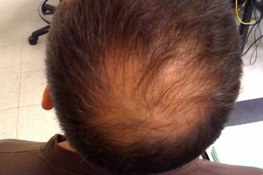 Bald-spot