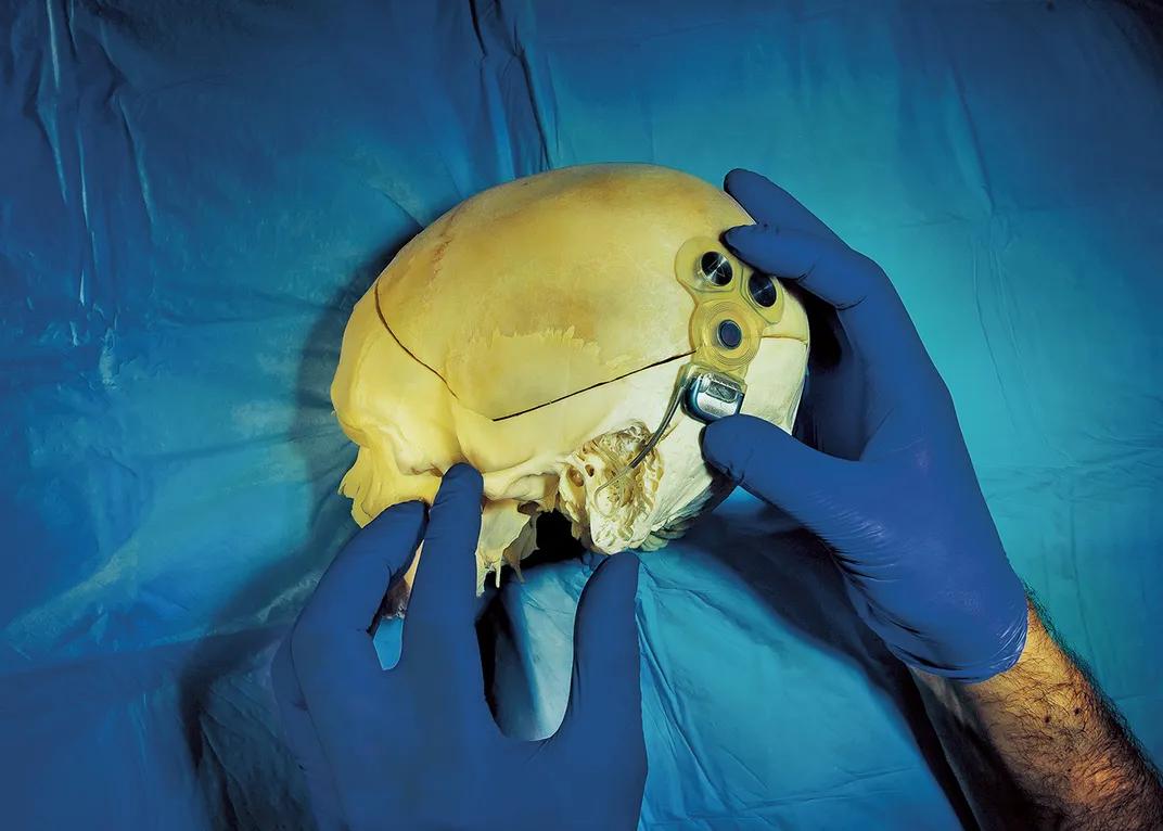 A vestibular implant on a human skull
