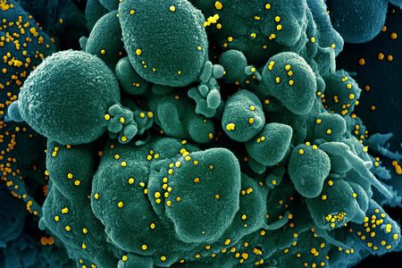 Colorized scanning electron micrograph of a cell (green) infected with SARS-COV-2 virus particles (yellow), isolated from a patient sample.
