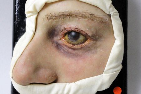 A skin affliction on display at the Moulage Museum.