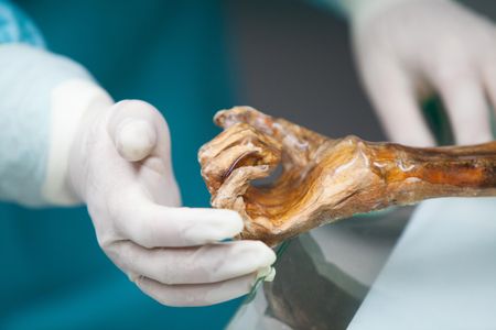 A researcher examines the mummified hand of Ötzi the Iceman.