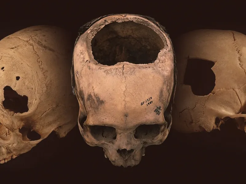 Inca Achievements In Medicine Inca Discoveries