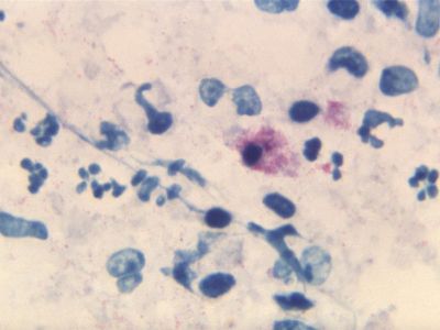 A stained tissue sample from 1967 reveals the presence of  Chlamydia psittaci bacteria. 