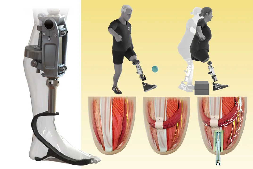 This New Bionic Knee Is Changing the Game for Lower Leg Amputees