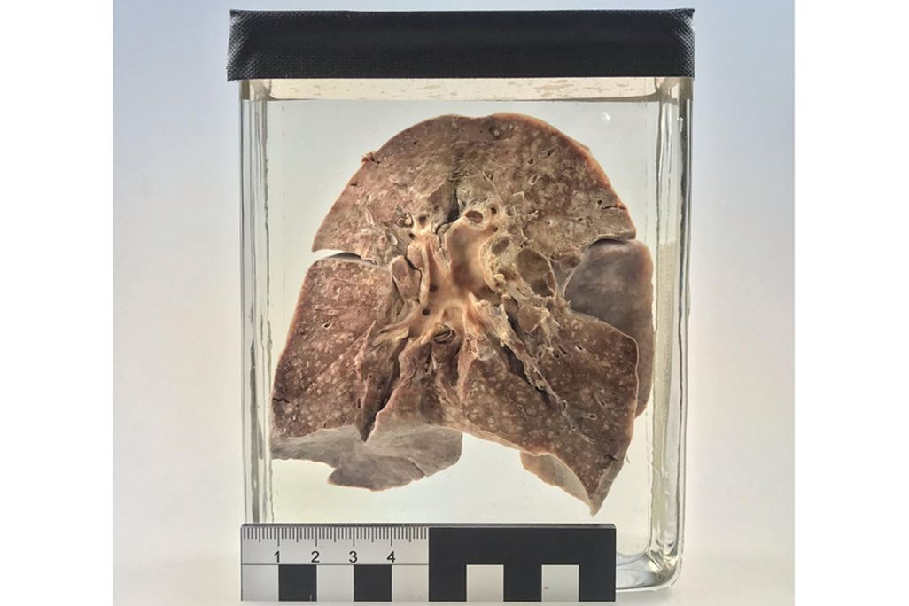 Measles lung