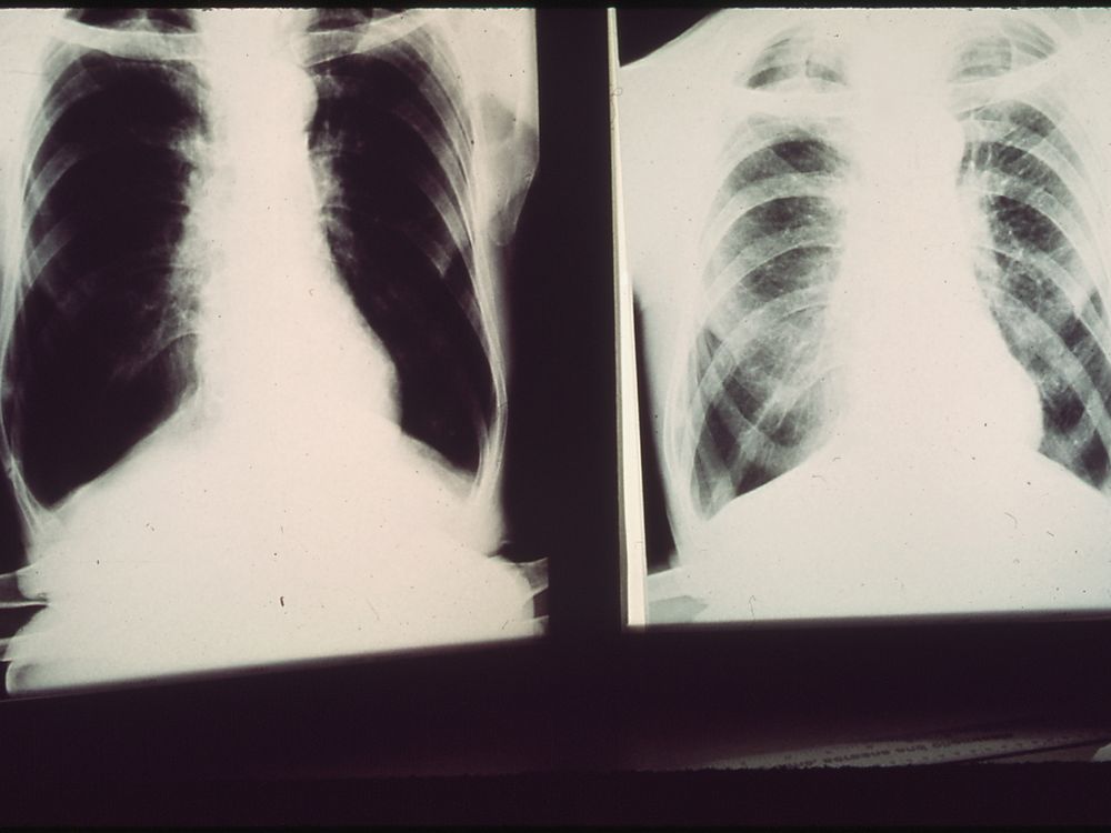 Black lung x-ray