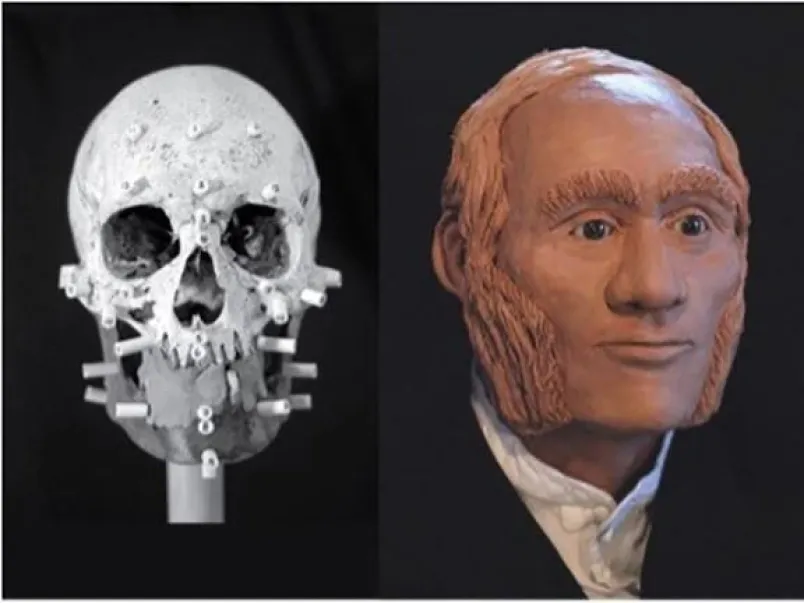Gregory facial reconstruction