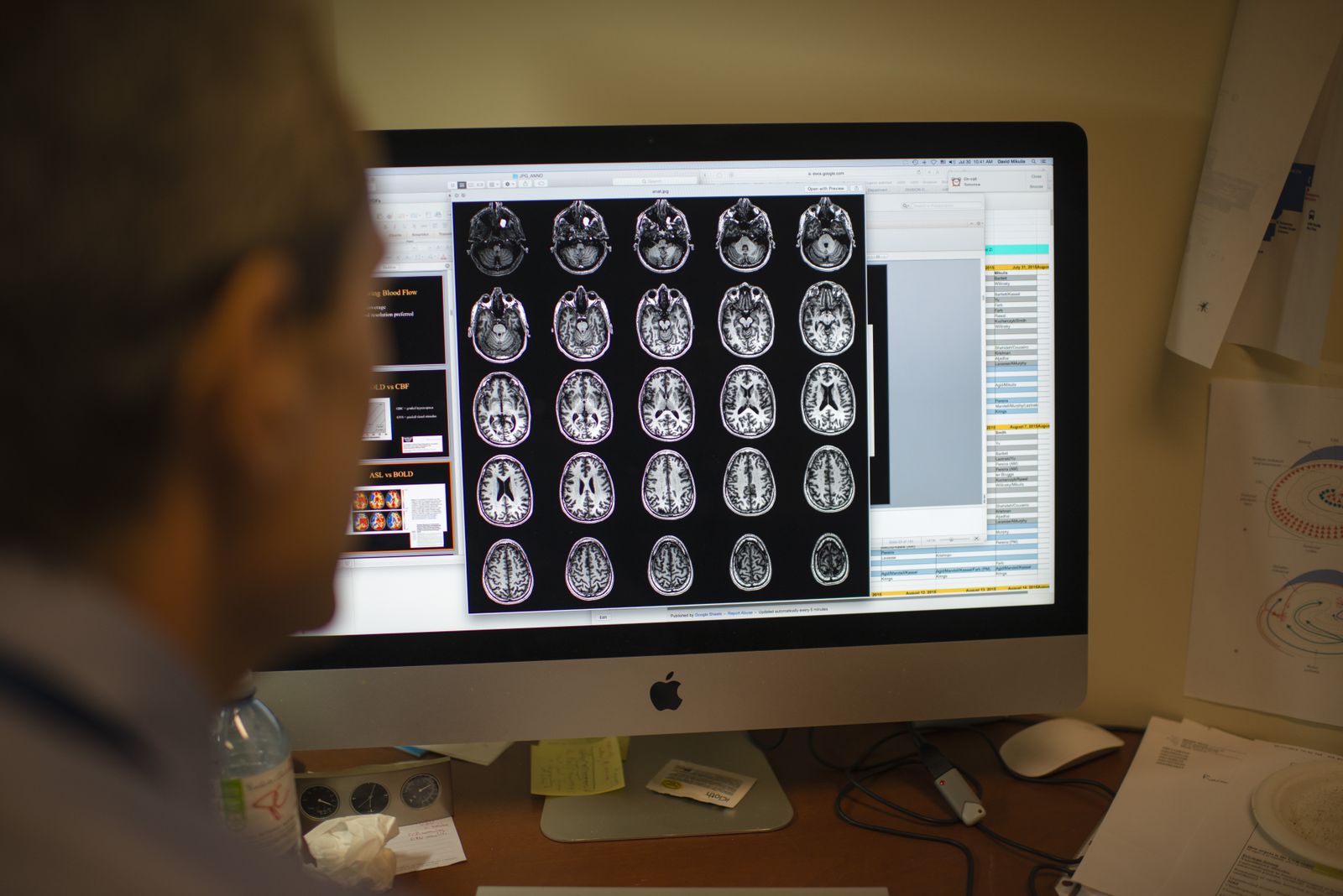 MRI Scans Might Reveal Signs of Alzheimer's Disease Seven Years Before a Telltale Marker Appears in the Brain