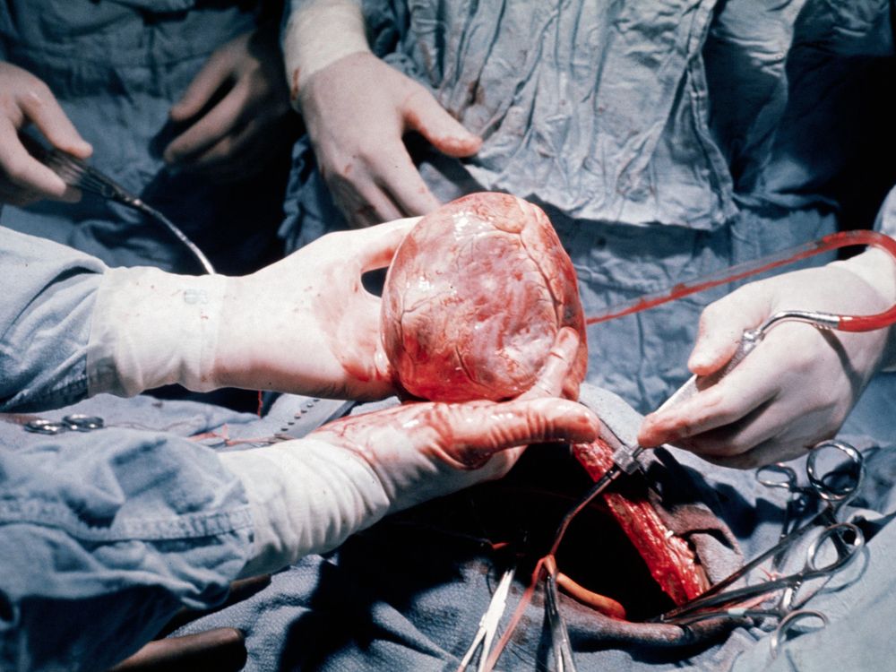 heart transplant