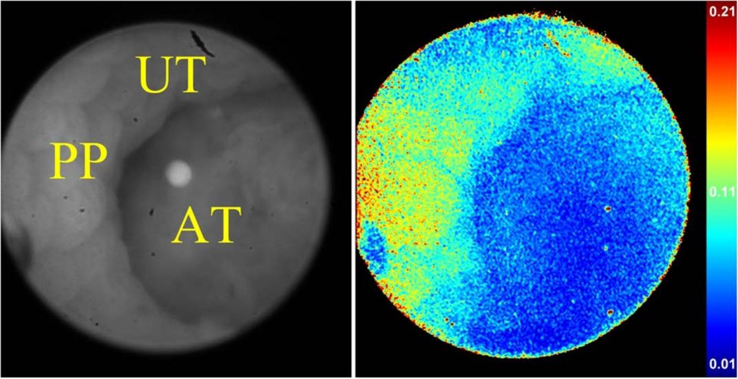 Polarized image of tumor in mouse colon