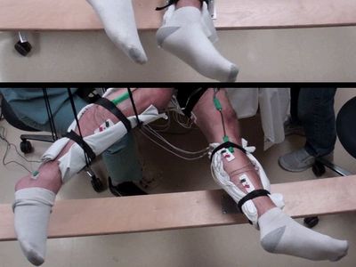 A paralyzed subject moves his legs with the help of transcutaneous stimulation.