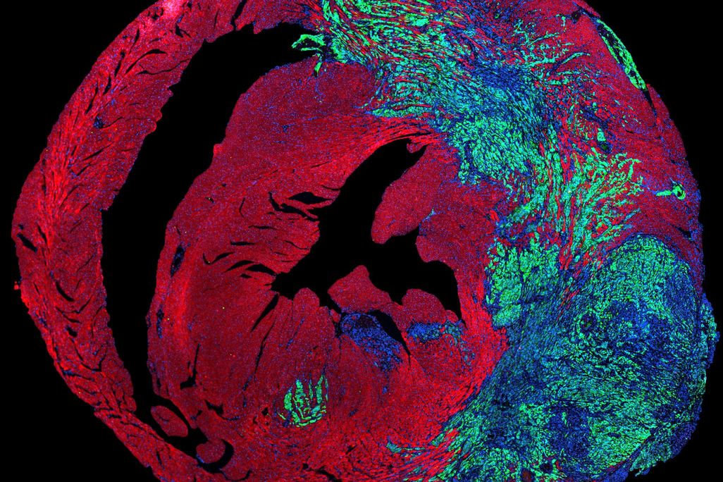 Image of lung cancer cells (in green) growing in a heart, in which cardiomyocytes are stained in red and uclei are stained in blue.