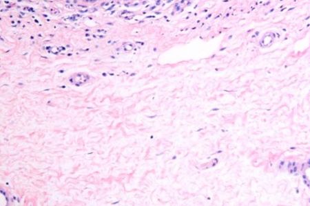The above image shows the dermal interstitium with bundles of collagen and fluid (white spaces).