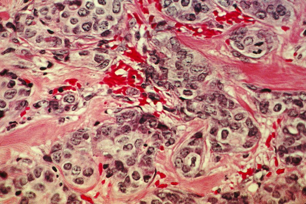 An image of cancerous breast tissue under a microscope. It has long strands of red and pink tissue with round, purple/blue cancer cells throughout.