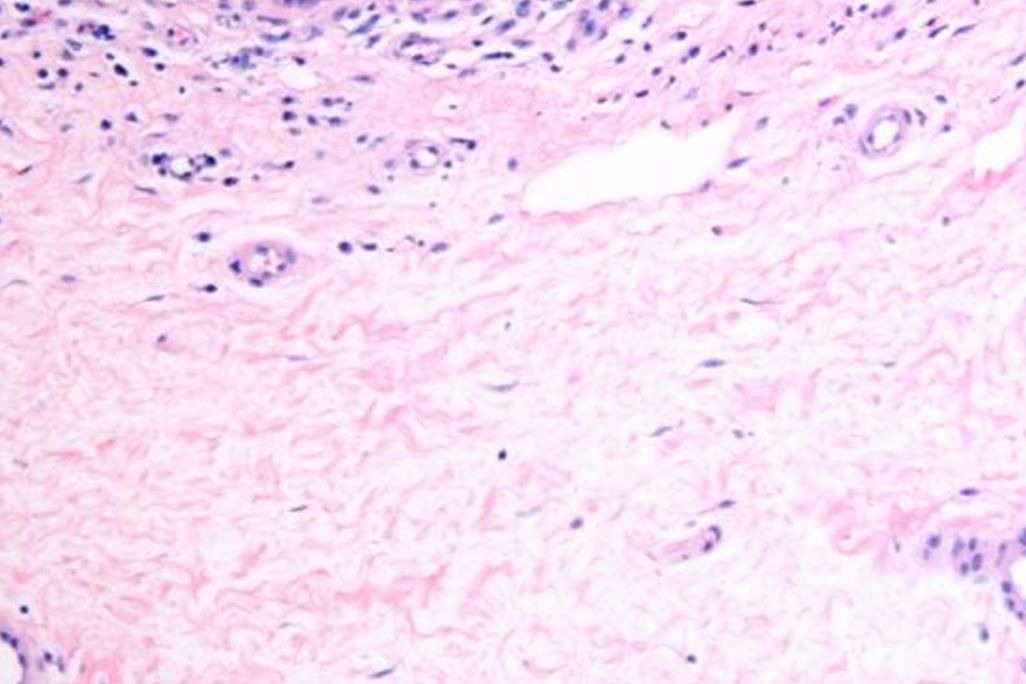 Dermal interstitium