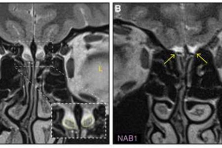 A brain with a normal olfactory bulb on the left and a brain lacking the bulb on the right.