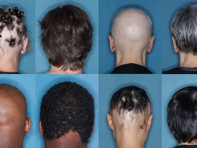 Before and after images of four study participants who recieved 36 weeks of treatment for severe alopecia areata with the drug baricitinib.