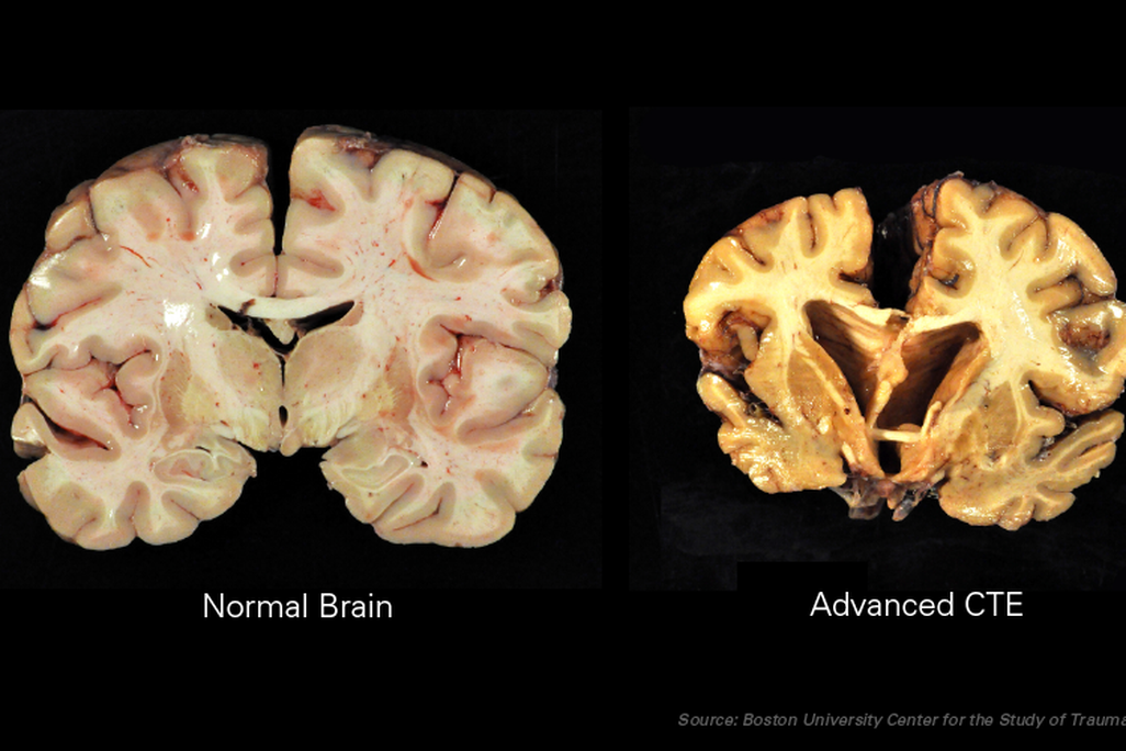 CTE Brains